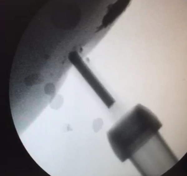 무침주사기의 피내 접종 모습(동영상 화면 캡처).